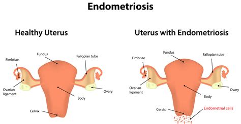 endometriosis definition in spanish